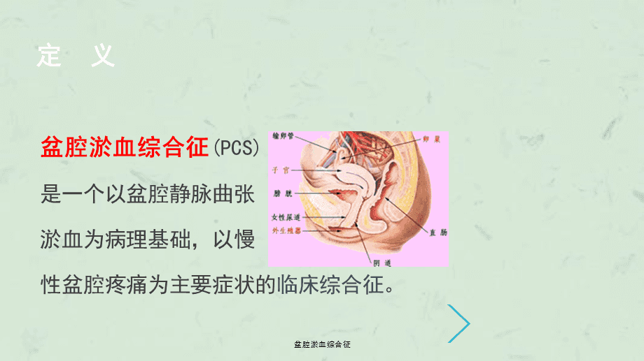 盆腔淤血症最新治疗法研究与应用