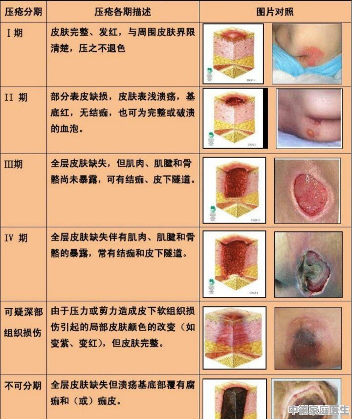 压疮的分期及临床表现最新版